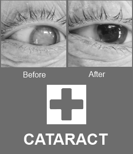Cataract BW