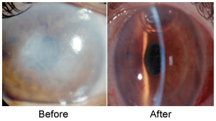cornea transplant before and after